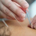 Image of acupuncture needles